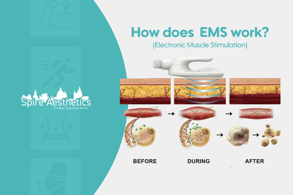 EMS treatment for post pregnancy weight loss treatment Wantage