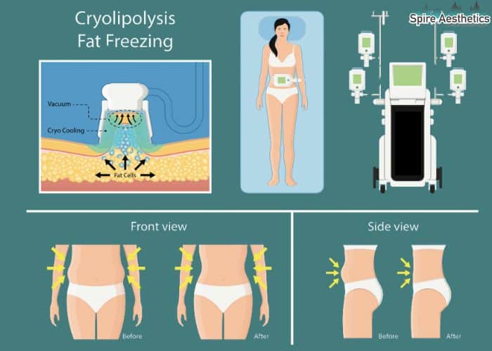 Image of diet and fat freezing combined for best results for Spire Aesthetics Wantage