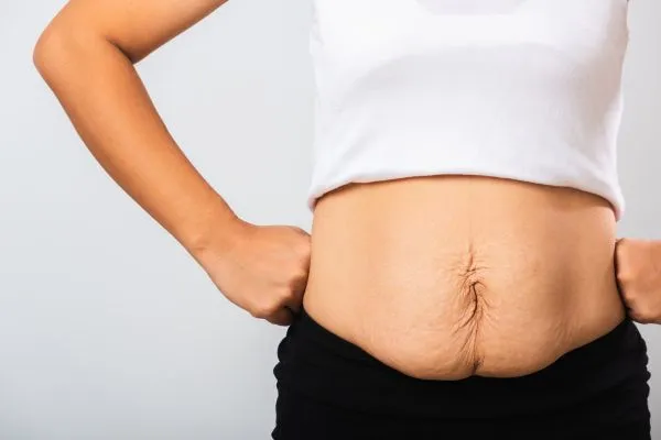 Image of a woman's stomach after weight loss with sagging skin following a gastric band Wantage