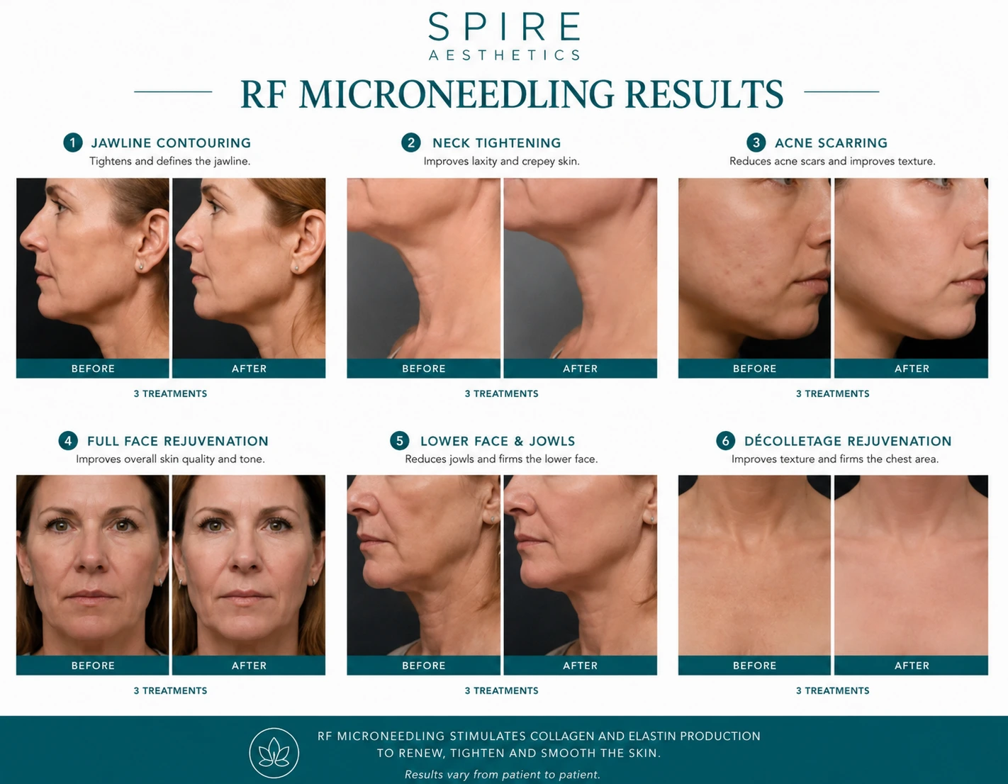 RF Microneedling Skin tightening Wantage results