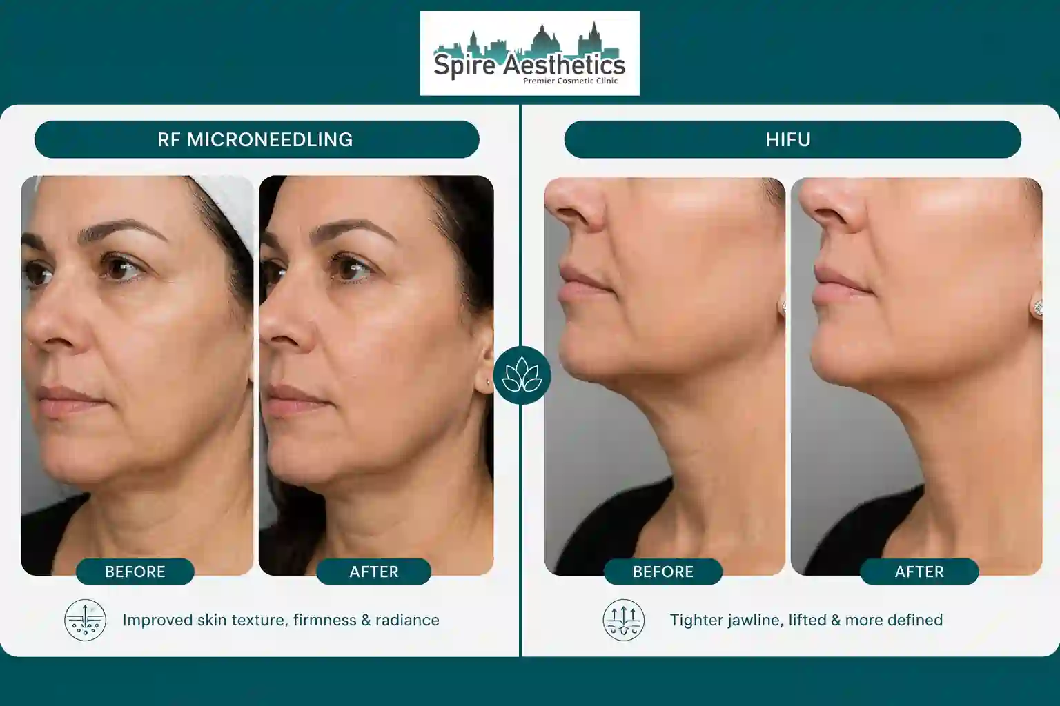 Can RF Microneedling and HIFU Be Combined Wantage?