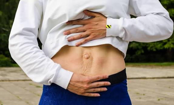 When Could Diastasis Recti Be the Missing Piece of the Puzzle Wantage?