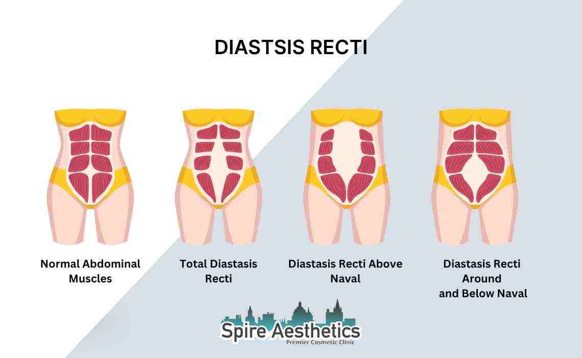 Is Non-Surgical Diastasis Recti Treatment Right for You? Common Concerns Answered Wantage